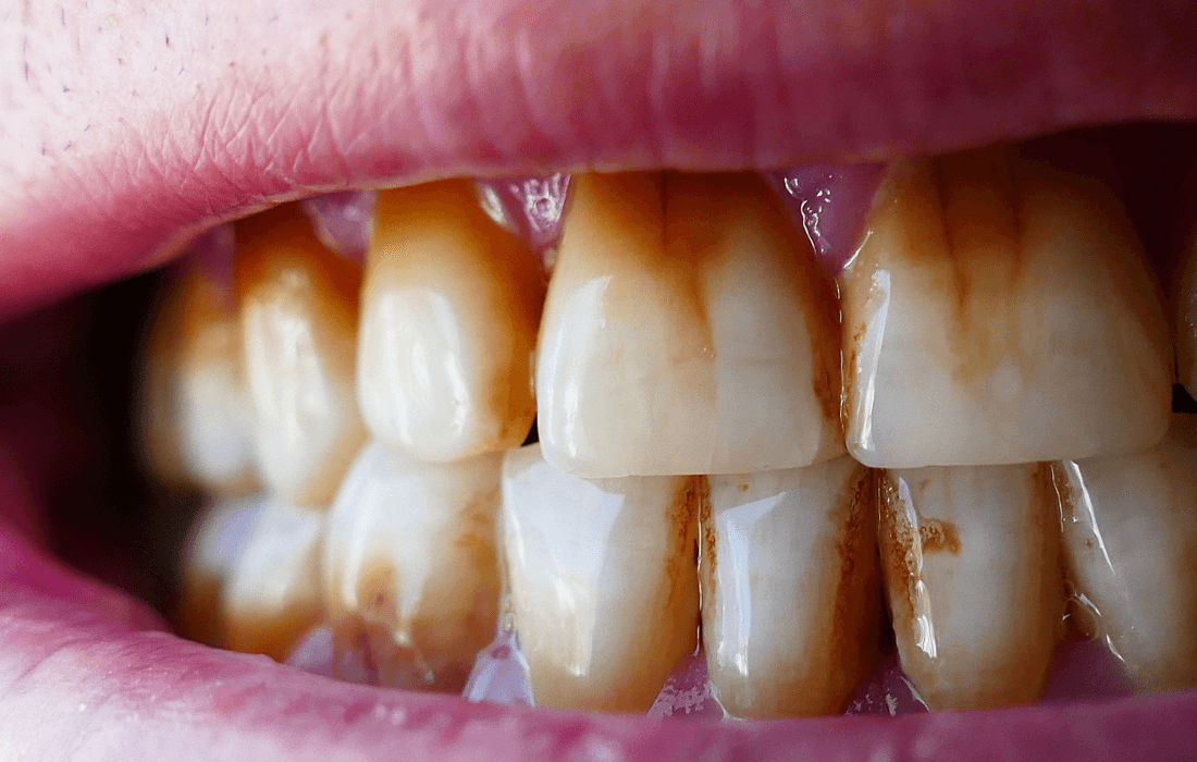 how to get rid of stains between teeth