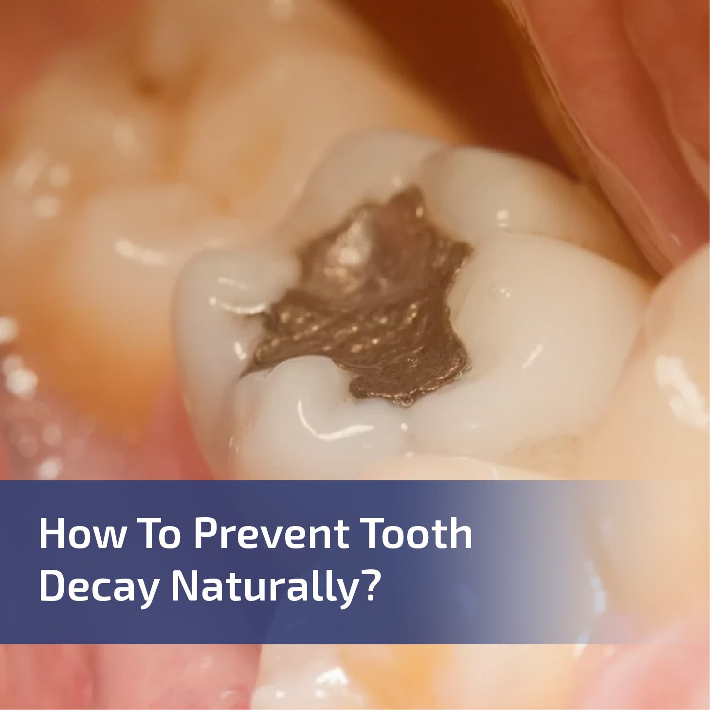 How to Prevent Tooth Decay Naturally