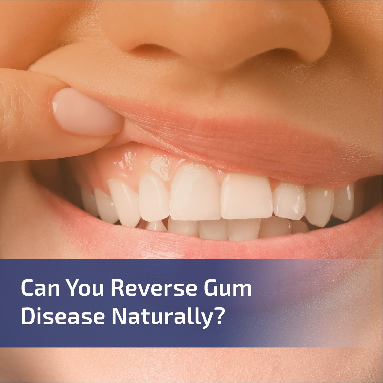 Can You Reverse Gum Disease Naturally?