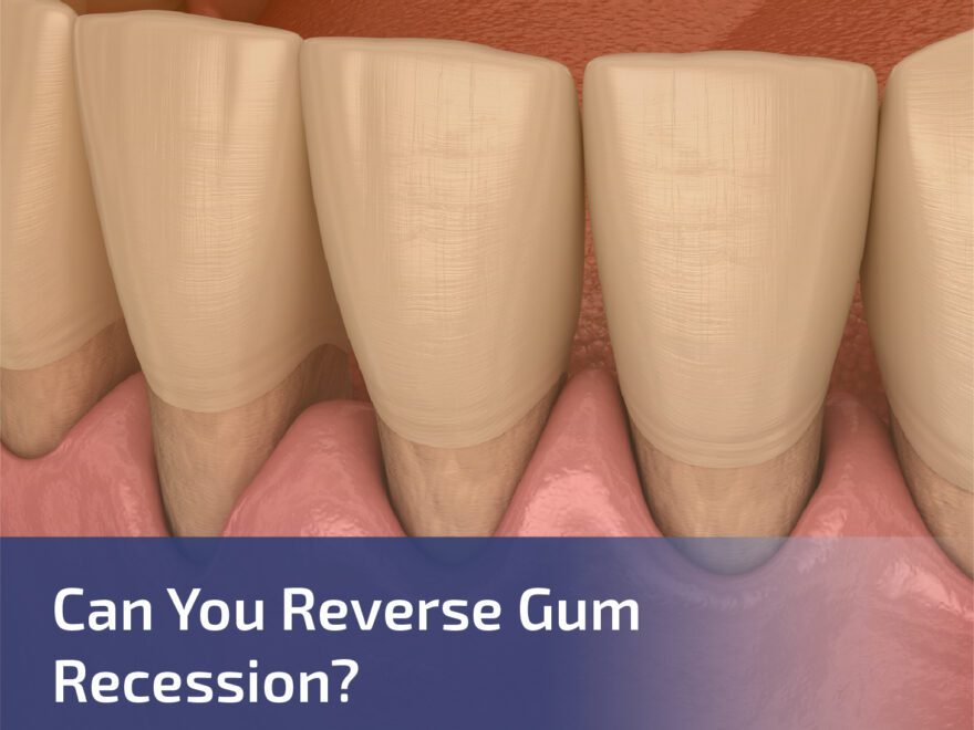 Can You Reverse the Gum Recession