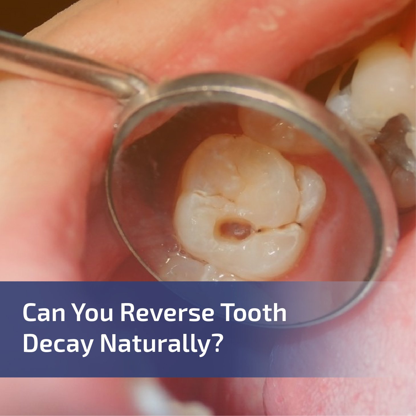 Can You Reverse Tooth Decay Naturally?