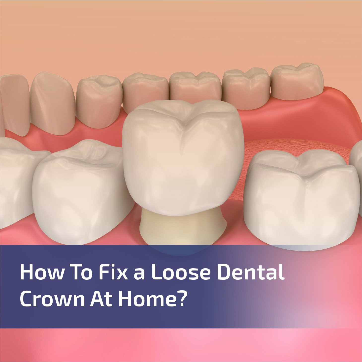 How to Fix a Loose Dental Crown At Home