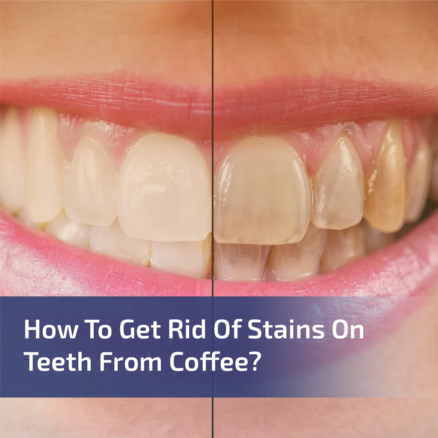 How to Get Rid of Stains on Teeth From Coffee