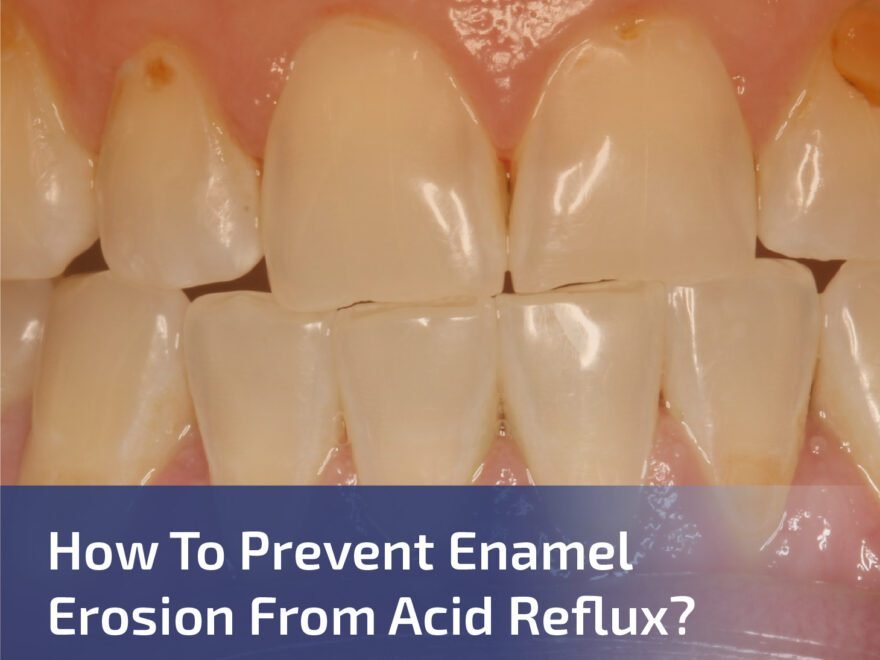 How to Prevent Enamel Erosion from Acid Reflux