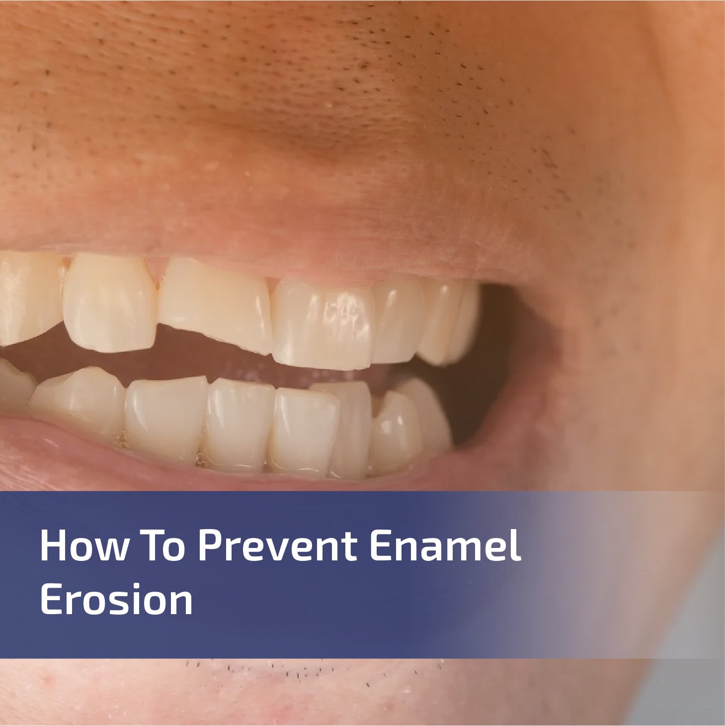 How to Prevent Enamel Erosion