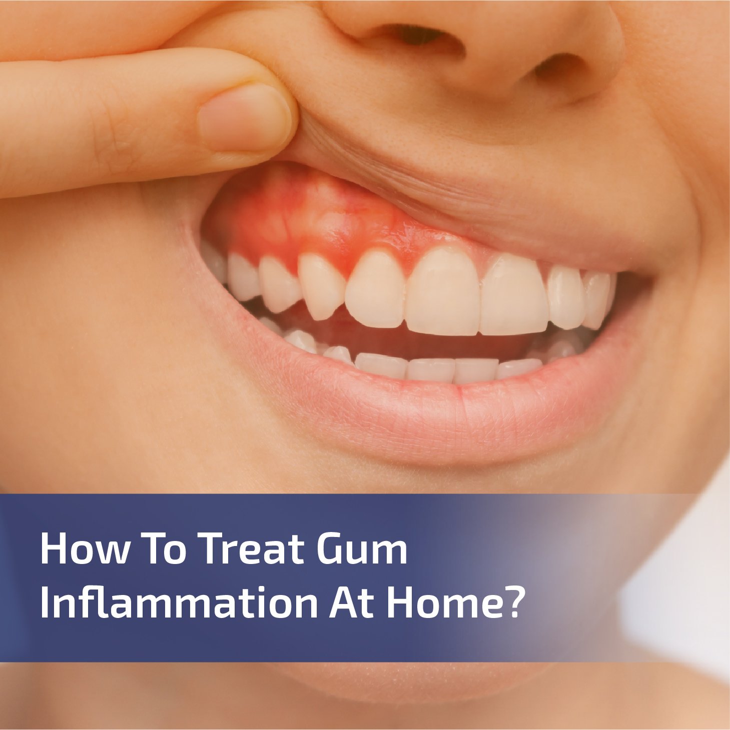 How to Treat Gum Inflammation at Home