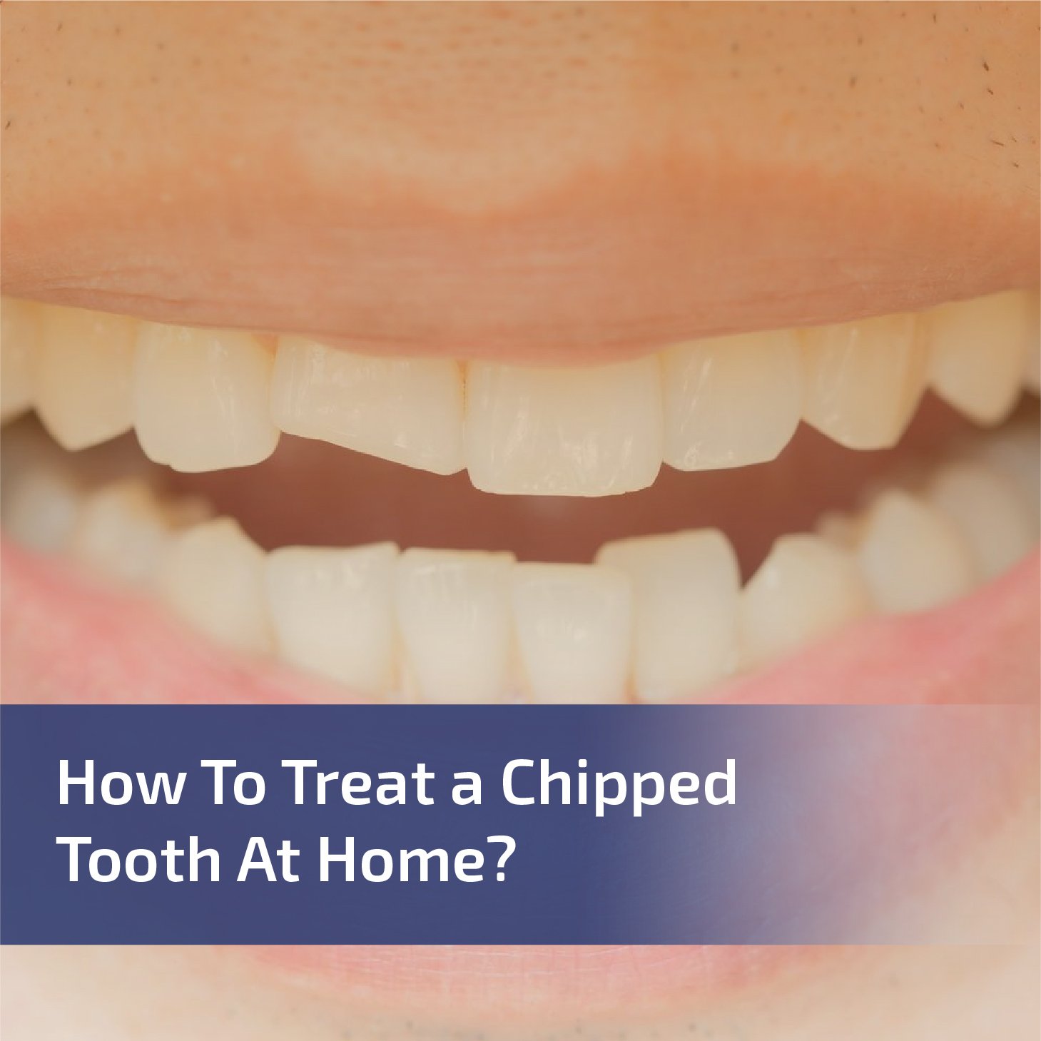 How to Treat a Chipped Tooth at Home