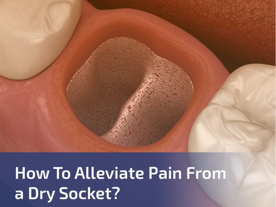 How to Alleviate Pain From a Dry Socket