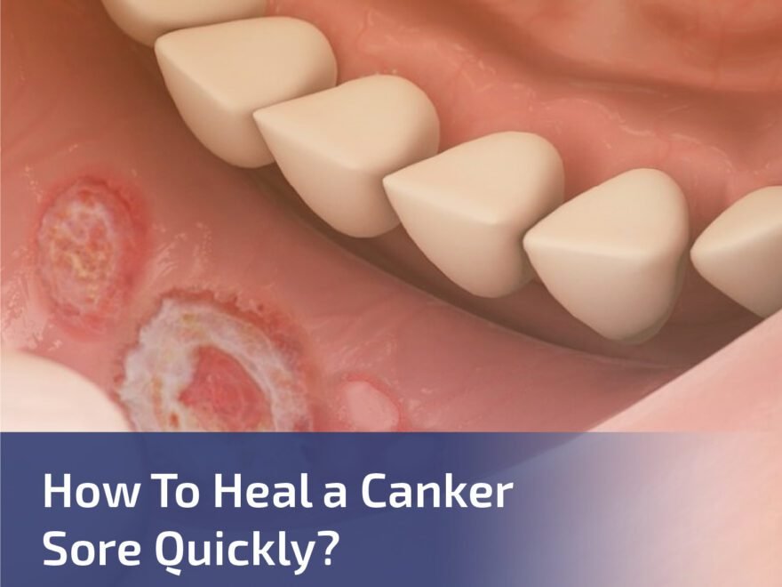 How to Heal a Canker Sore Quickly