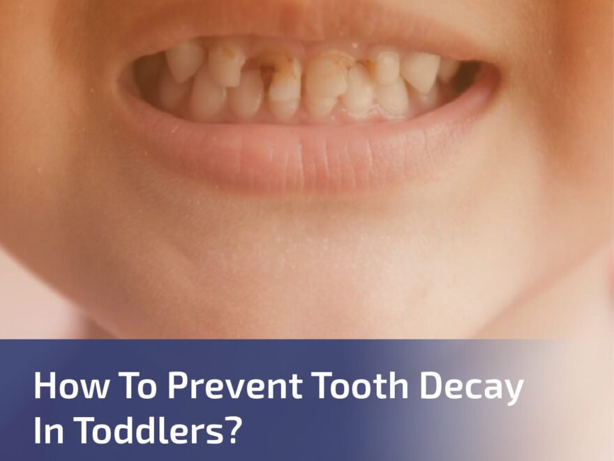 How to Prevent Tooth Decay in Toddlers