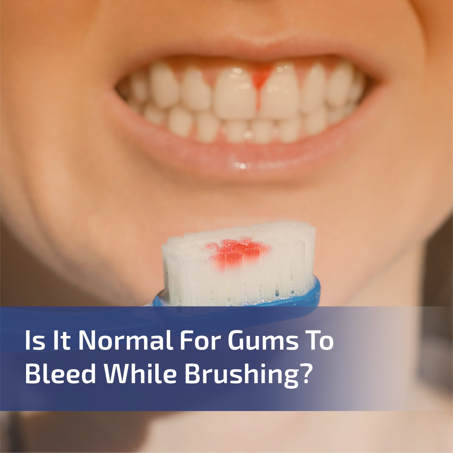 Is It Normal for Gums to Bleed While Brushing?