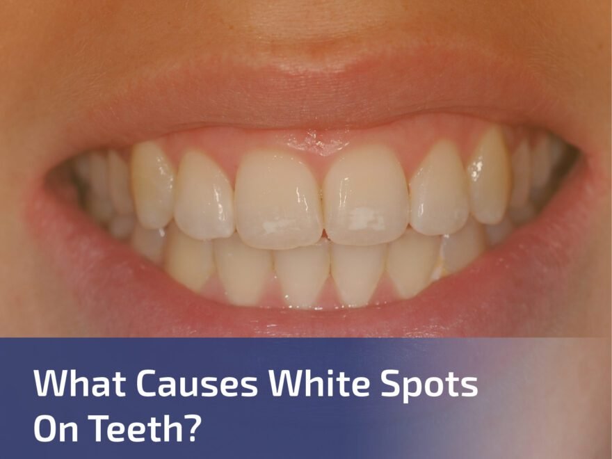 What Causes White Spots on Teeth?